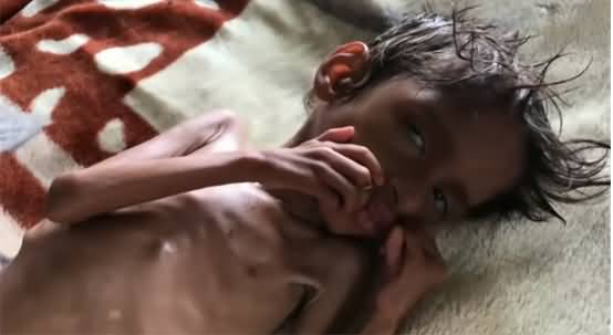 Yemen Crisis: Five Years of Hunger, Thousands of Children on The Verge of Death